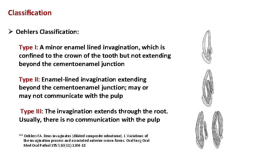 Classiﬁcation Ø Oehlers Classification: Type I: A minor enamel lined invagination, which is conﬁned