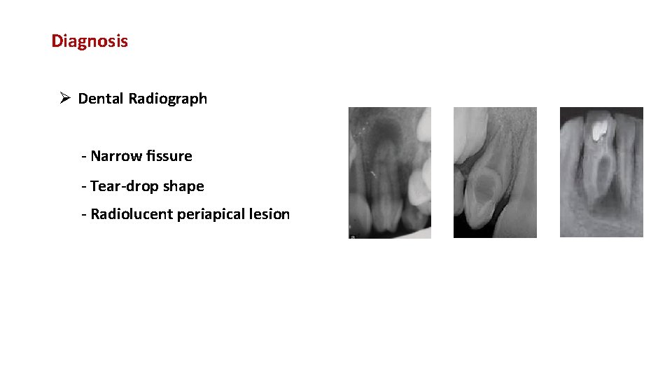 Diagnosis Ø Dental Radiograph - Narrow ﬁssure - Tear-drop shape - Radiolucent periapical lesion