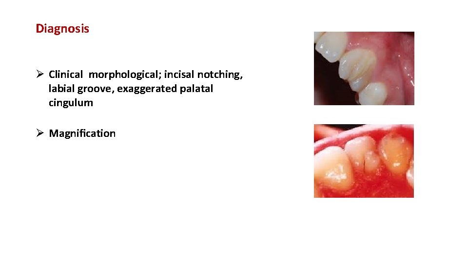 Diagnosis Ø Clinical morphological; incisal notching, labial groove, exaggerated palatal cingulum Ø Magniﬁcation 