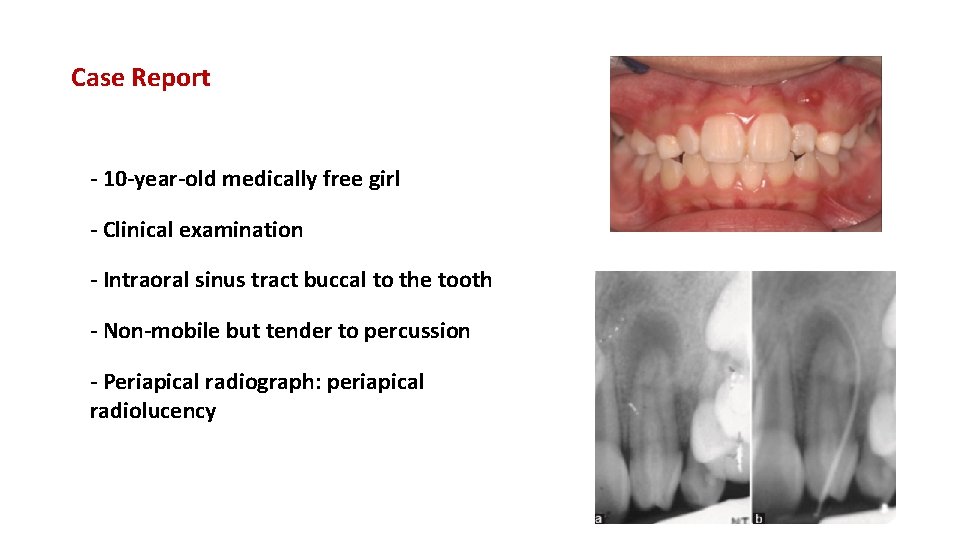 Case Report - 10 -year-old medically free girl - Clinical examination - Intraoral sinus