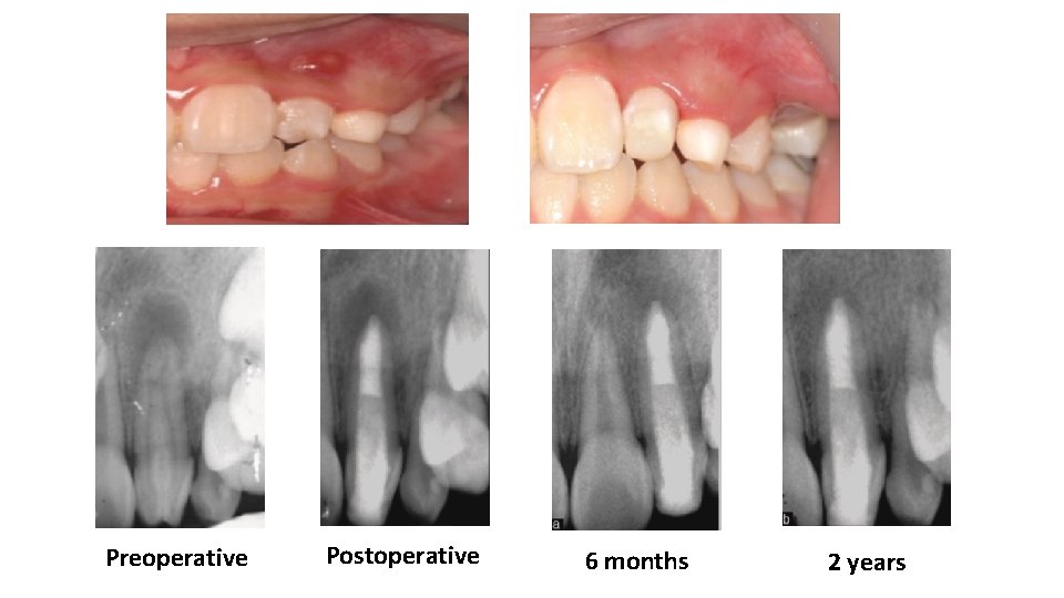 Preoperative Postoperative 6 months 2 years 