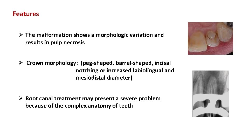 Features Ø The malformation shows a morphologic variation and results in pulp necrosis Ø