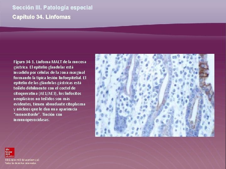 Sección III. Patología especial Capítulo 34. Linfomas Figura 34 -1. Linfoma MALT de la