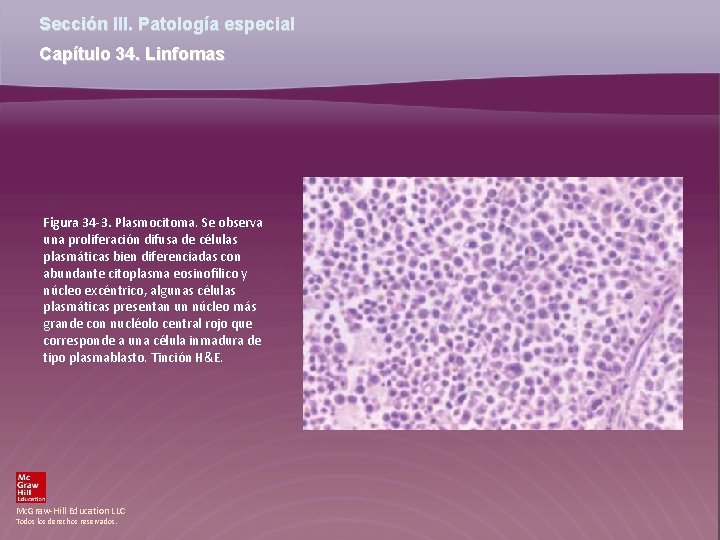 Sección III. Patología especial Capítulo 34. Linfomas Figura 34 -3. Plasmocitoma. Se observa una