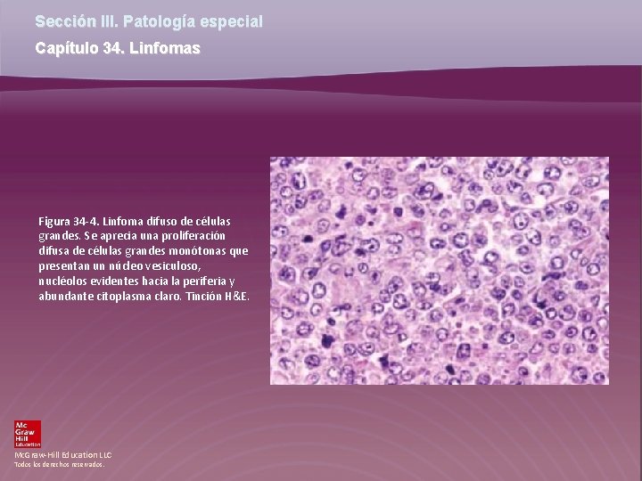 Sección III. Patología especial Capítulo 34. Linfomas Figura 34 -4. Linfoma difuso de células