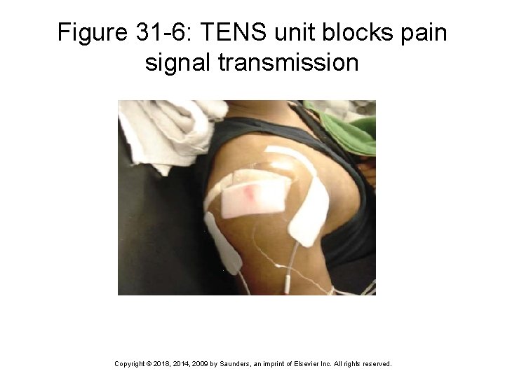 Figure 31 -6: TENS unit blocks pain signal transmission Copyright © 2018, 2014, 2009