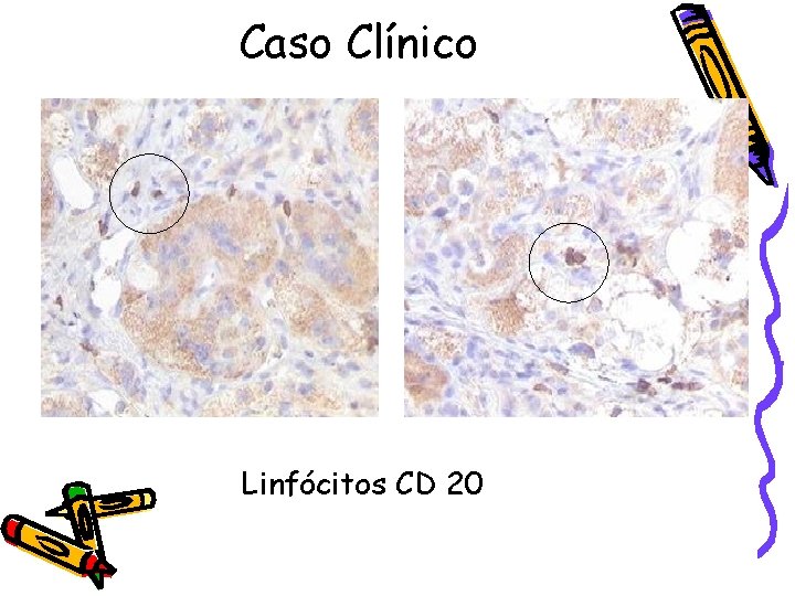 Caso Clínico Linfócitos CD 20 