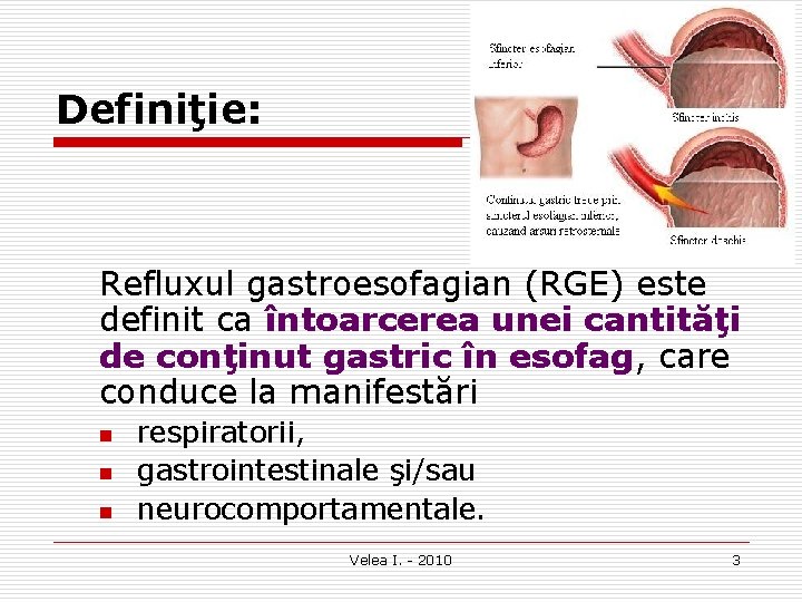 Definiţie: Refluxul gastroesofagian (RGE) este definit ca întoarcerea unei cantităţi de conţinut gastric în