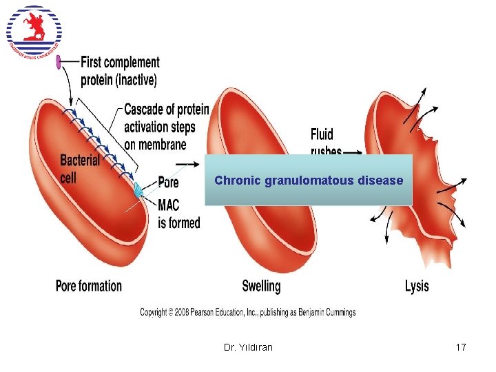 Chronic granulomatous disease Dr. Yıldıran 17 