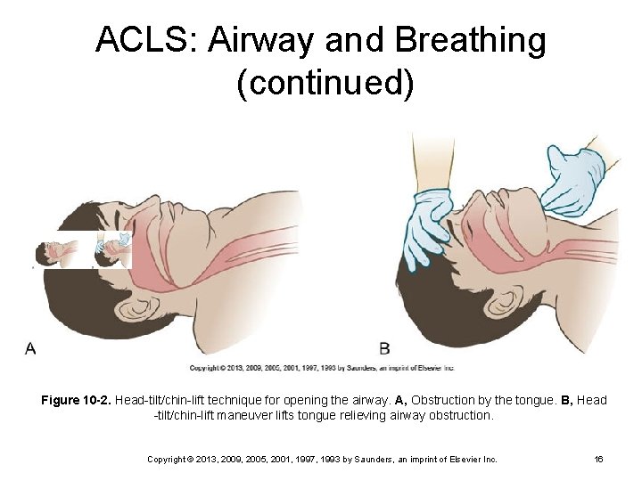 ACLS: Airway and Breathing (continued) Figure 10 -2. Head-tilt/chin-lift technique for opening the airway.