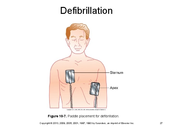 Defibrillation Figure 10 -7. Paddle placement for defibrillation. Copyright © 2013, 2009, 2005, 2001,
