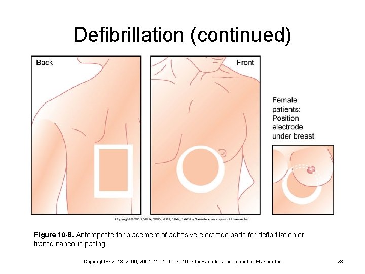 Defibrillation (continued) Figure 10 -8. Anteroposterior placement of adhesive electrode pads for defibrillation or