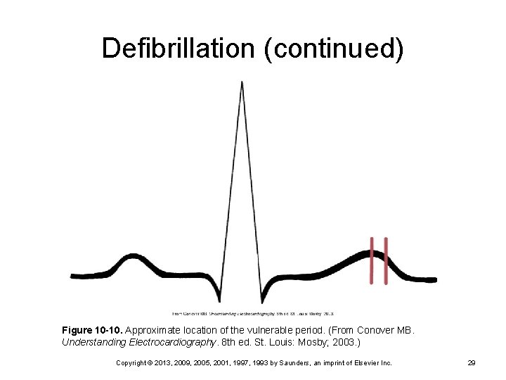 Defibrillation (continued) Figure 10 -10. Approximate location of the vulnerable period. (From Conover MB.