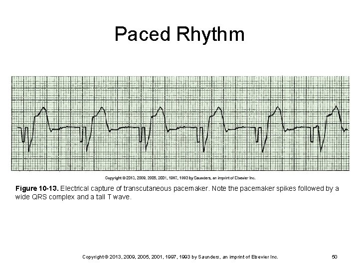 Paced Rhythm Figure 10 -13. Electrical capture of transcutaneous pacemaker. Note the pacemaker spikes
