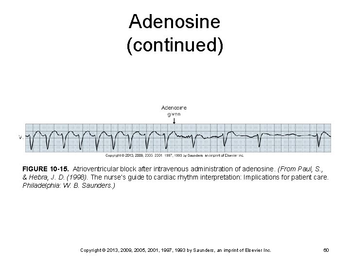 Adenosine (continued) FIGURE 10 -15. Atrioventricular block after intravenous administration of adenosine. (From Paul,