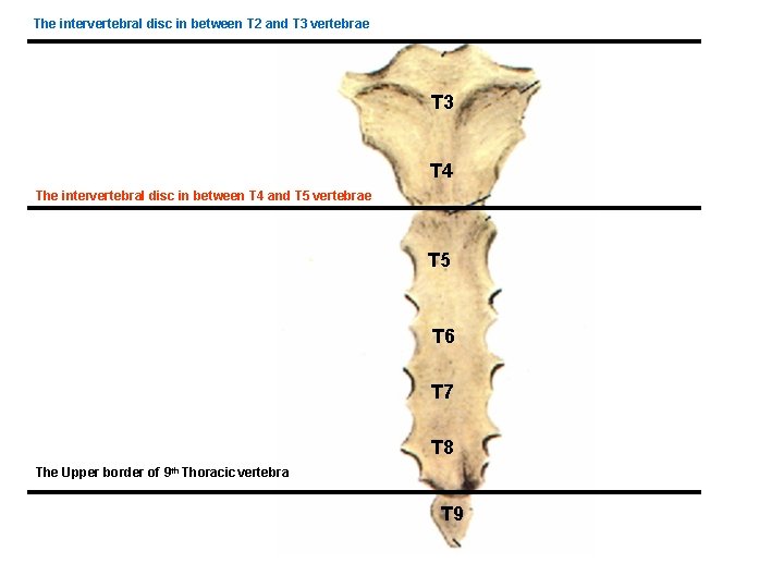 The intervertebral disc in between T 2 and T 3 vertebrae T 3 T