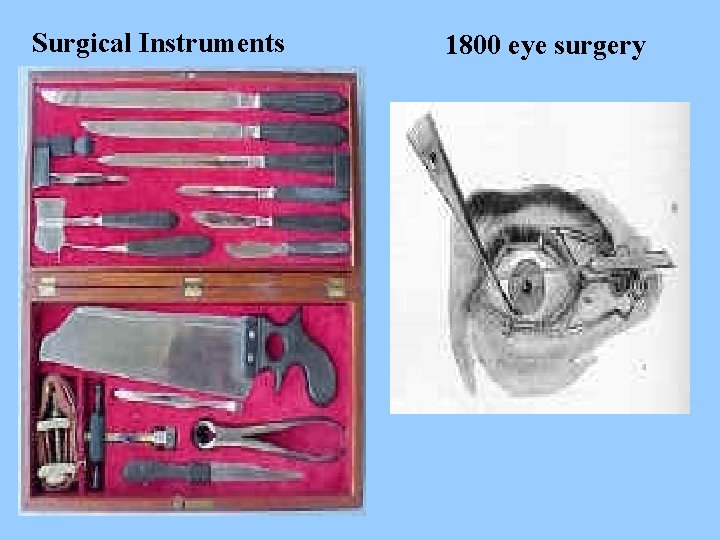 Surgical Instruments 1800 eye surgery 