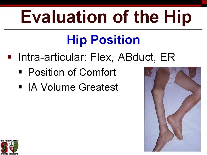 Evaluation of the Hip Position § Intra-articular: Flex, ABduct, ER § Position of Comfort