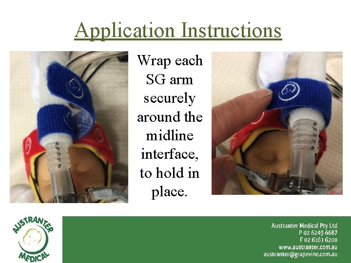 Application Instructions Wrap each SG arm securely around the midline interface, to hold in