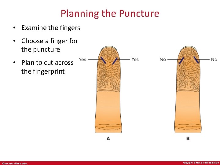 Planning the Puncture • Examine the fingers • Choose a finger for the puncture Planning the Puncture • Examine the fingers • Choose a finger for the puncture