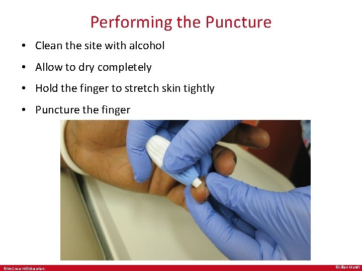 Performing the Puncture • Clean the site with alcohol • Allow to dry completely