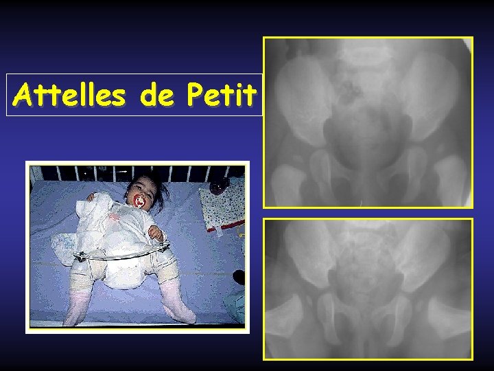 Attelles de Petit 