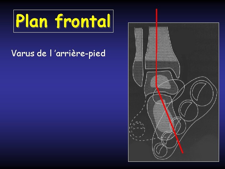 Plan frontal Varus de l ’arrière-pied 