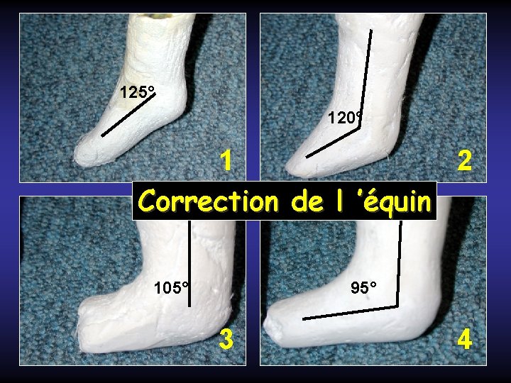 125° 120° 1 2 Correction de l ’équin 105° 95° 3 4 