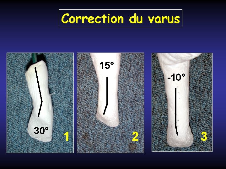 Correction du varus 15° -10° 30° 1 2 3 