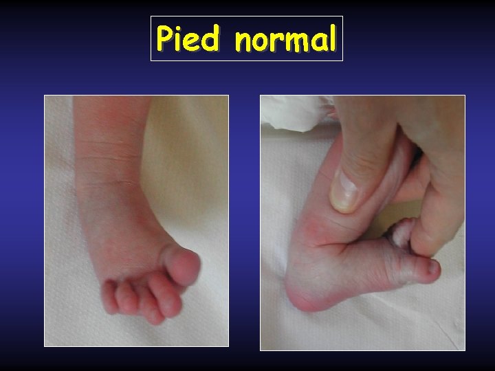 Pied normal 