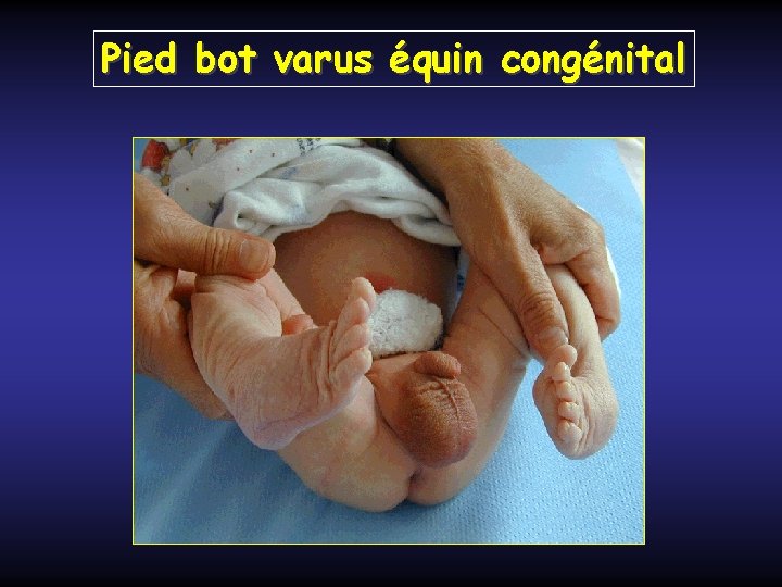 Pied bot varus équin congénital 