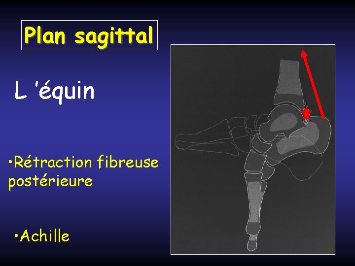 Plan sagittal L ’équin • Rétraction fibreuse postérieure • Achille 