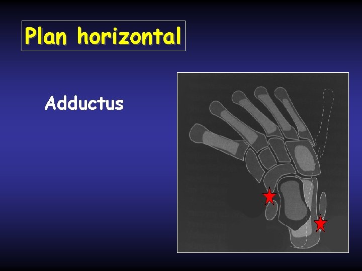 Plan horizontal Adductus 