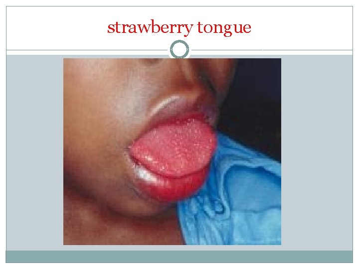 strawberry tongue 