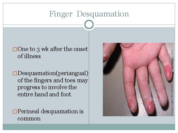 Finger Desquamation � One to 3 wk after the onset of illness � Desquamation(periangual)