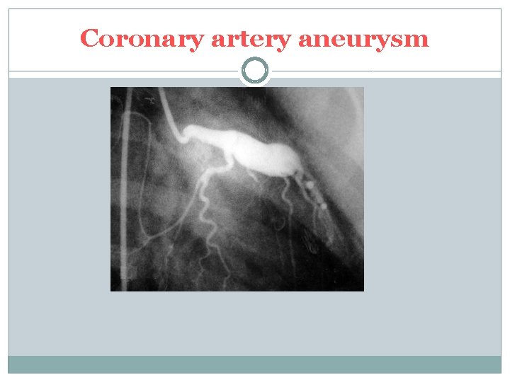 Coronary artery aneurysm 