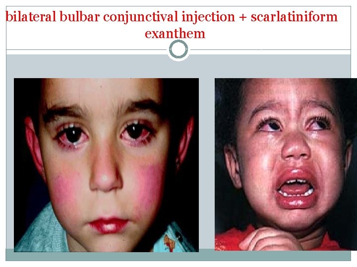 bilateral bulbar conjunctival injection + scarlatiniform exanthem 