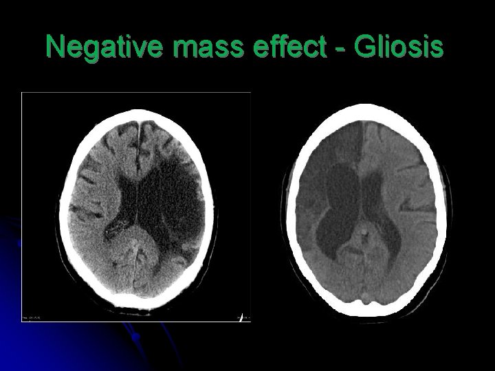 Negative mass effect - Gliosis 