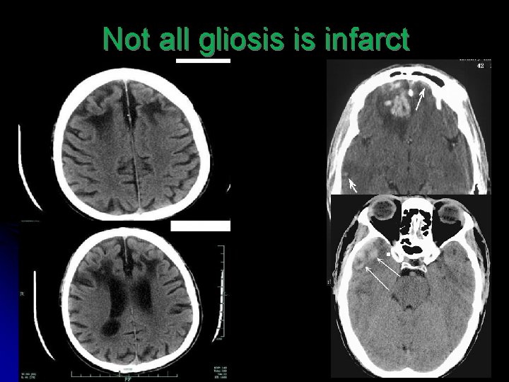 Not all gliosis is infarct 