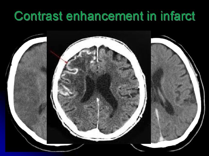 Contrast enhancement in infarct 