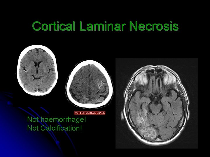 Cortical Laminar Necrosis Not haemorrhage! Not Calcification! 