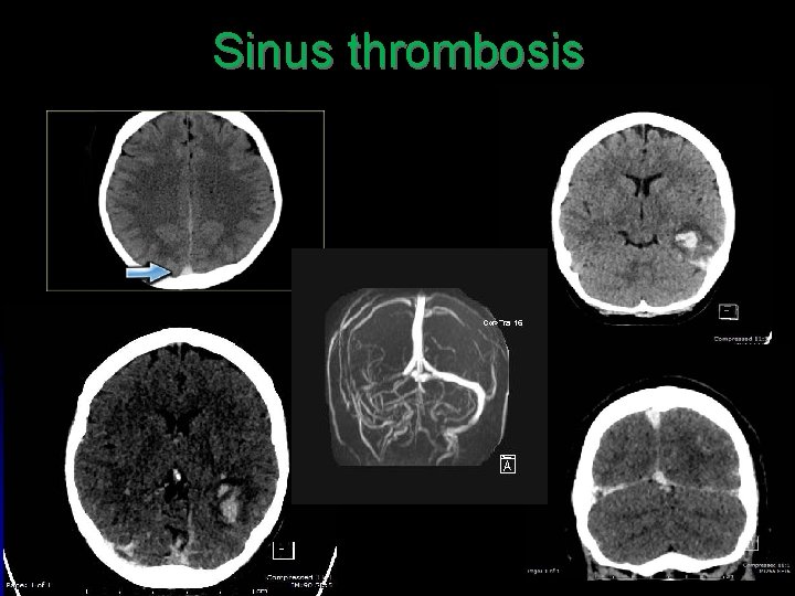 Sinus thrombosis 