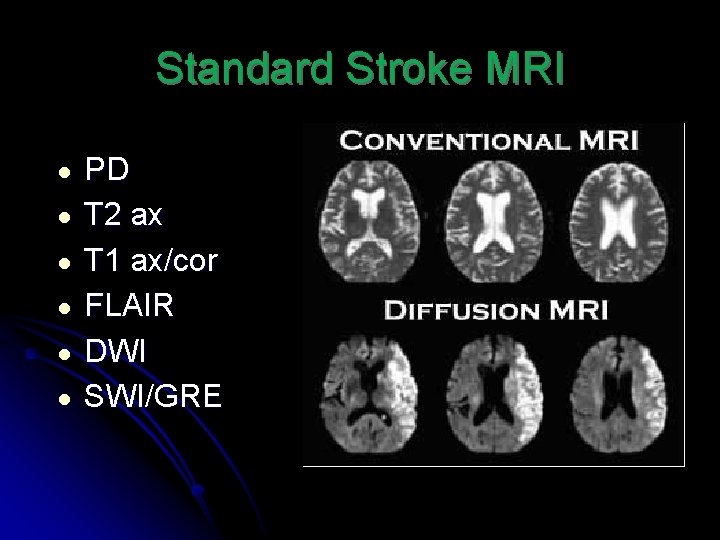 Standard Stroke MRI ● ● ● PD T 2 ax T 1 ax/cor FLAIR