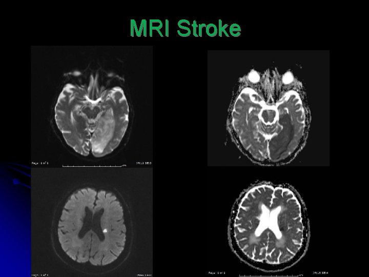MRI Stroke 