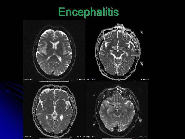 Encephalitis 