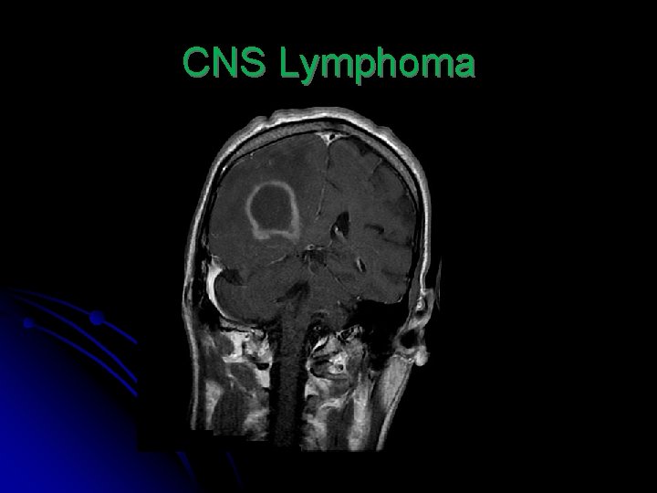 CNS Lymphoma 