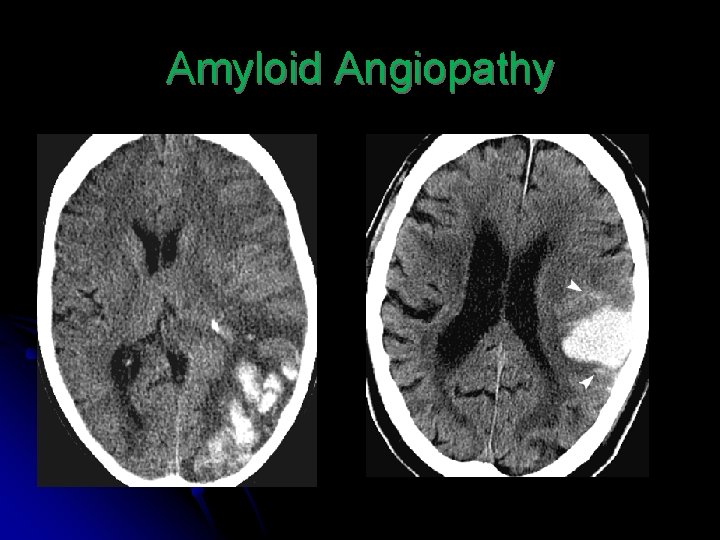 Amyloid Angiopathy 