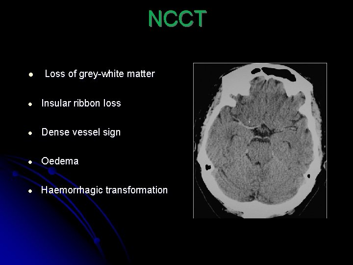 NCCT ● Loss of grey-white matter ● Insular ribbon loss ● Dense vessel sign