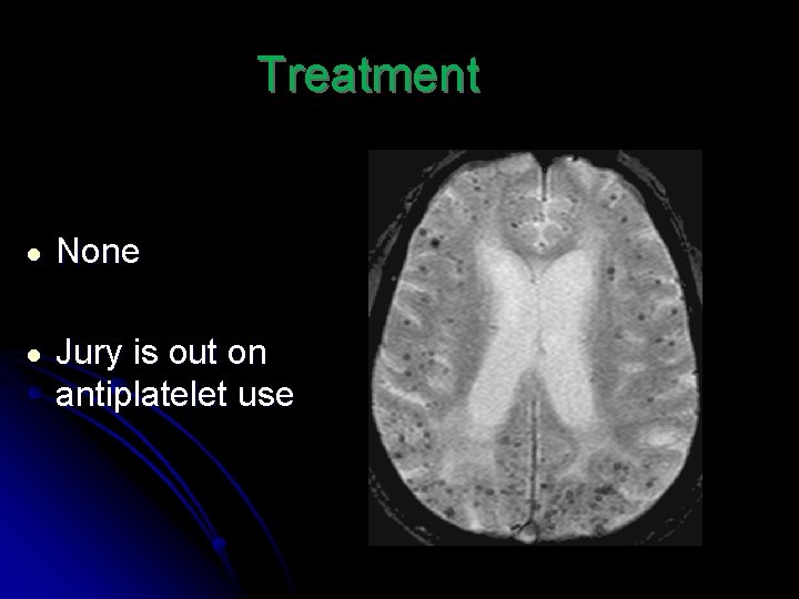 Treatment ● None ● Jury is out on antiplatelet use 