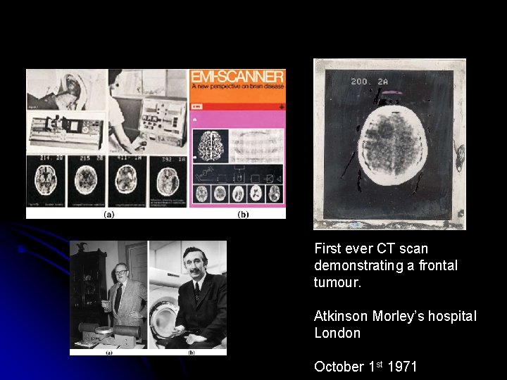 First ever CT scan demonstrating a frontal tumour. Atkinson Morley’s hospital London October 1